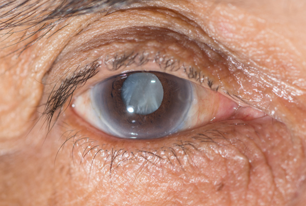 Cataract Eye Surgery